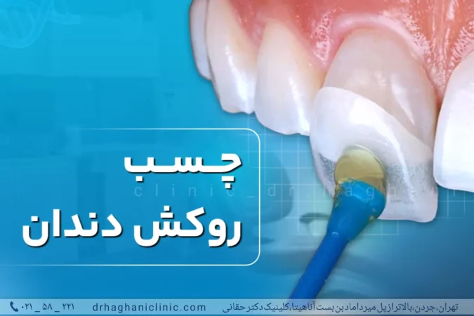 چسب روکش دندان