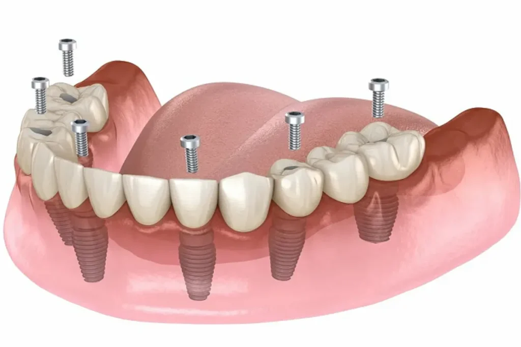 پروتز ایمپلنت ثابت