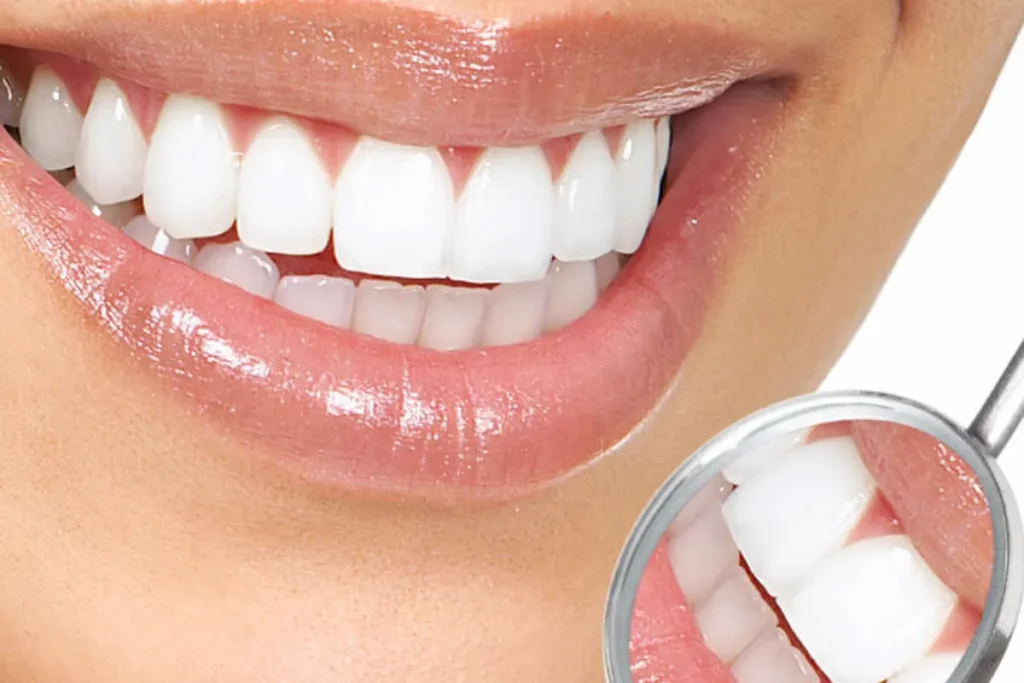 مدت ماندگاری بلیچینگ دندان