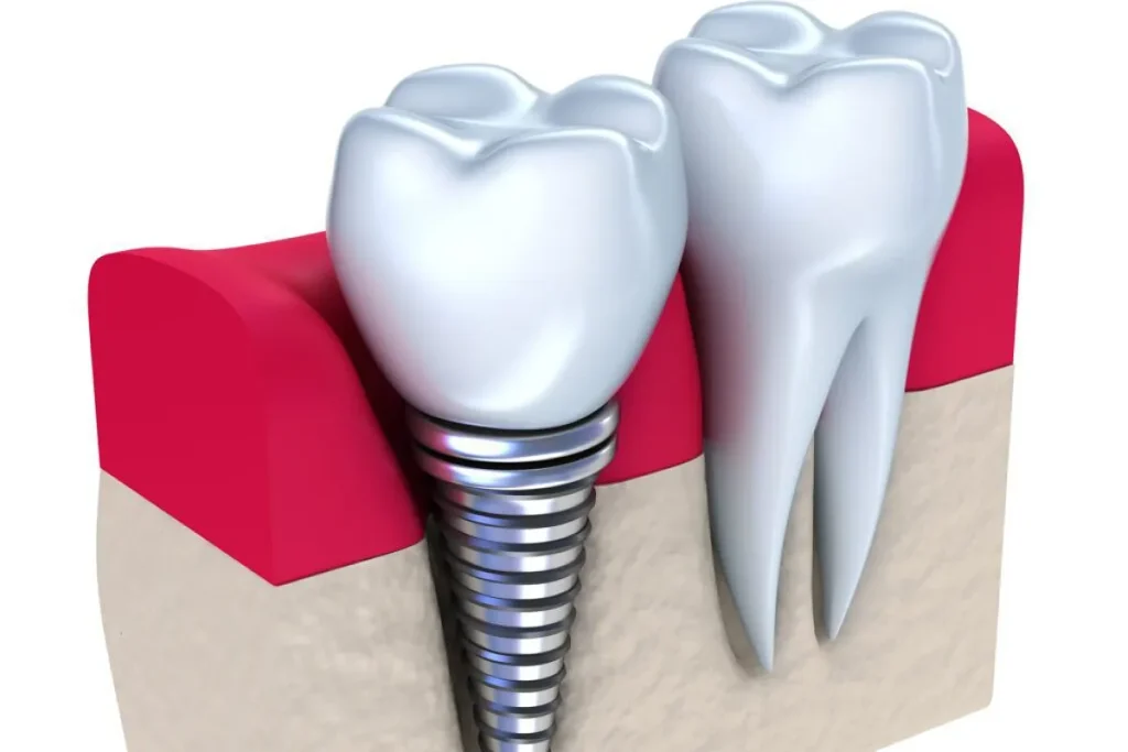 ایمپلنت طبیعی