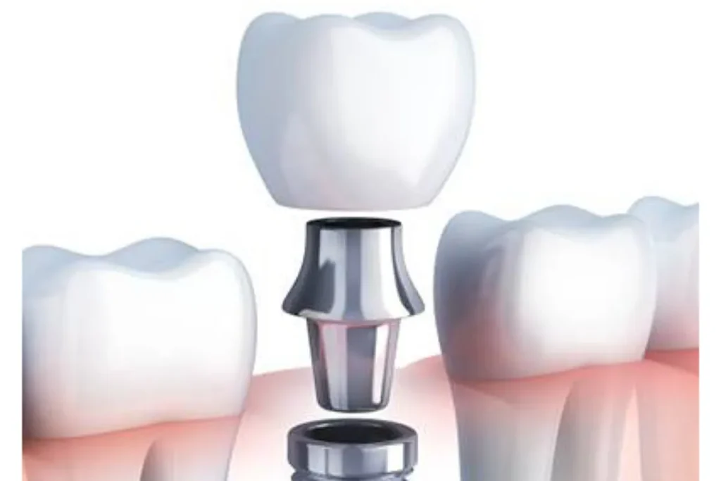 ایمپلنت دندان براساس کشور سازنده ایمپلنت 