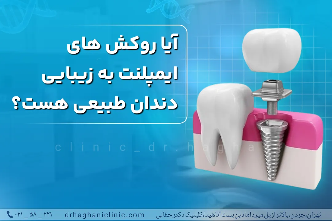 زیبایی روکش ایمپلنت