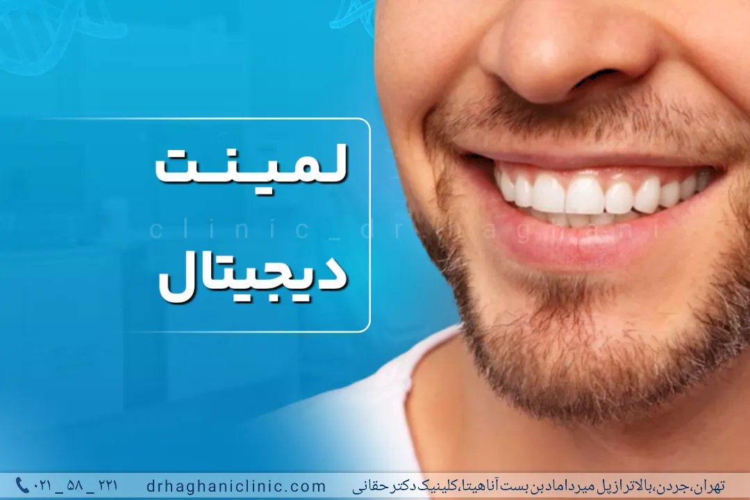 لمینت دیجیتال