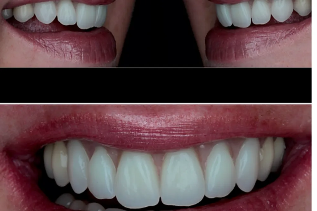 انجام لمینت دیجیتالی دندان ها