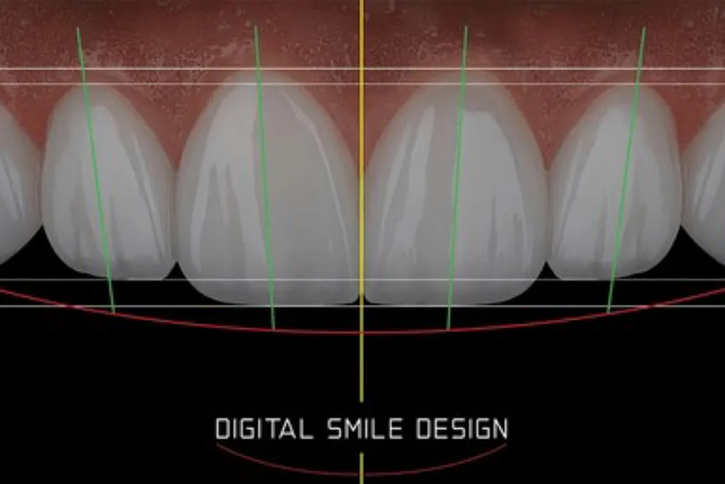 طراحی لبخند دیجیتال با لمینت‌ دیجیتال در کلینیک دندانپزشکی دکتر حقانی در تهران 