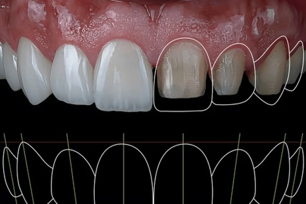 لمینت دیجیتال دندان ها با دقت و ظرافت 