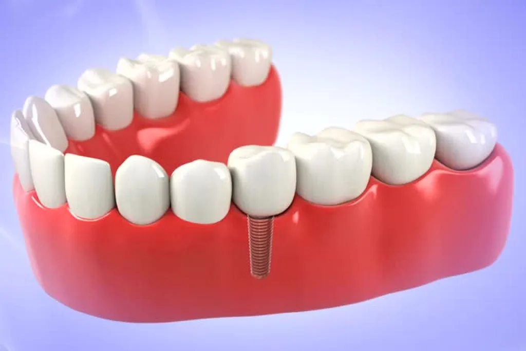 ایمپلنت دندان بدون جراحی