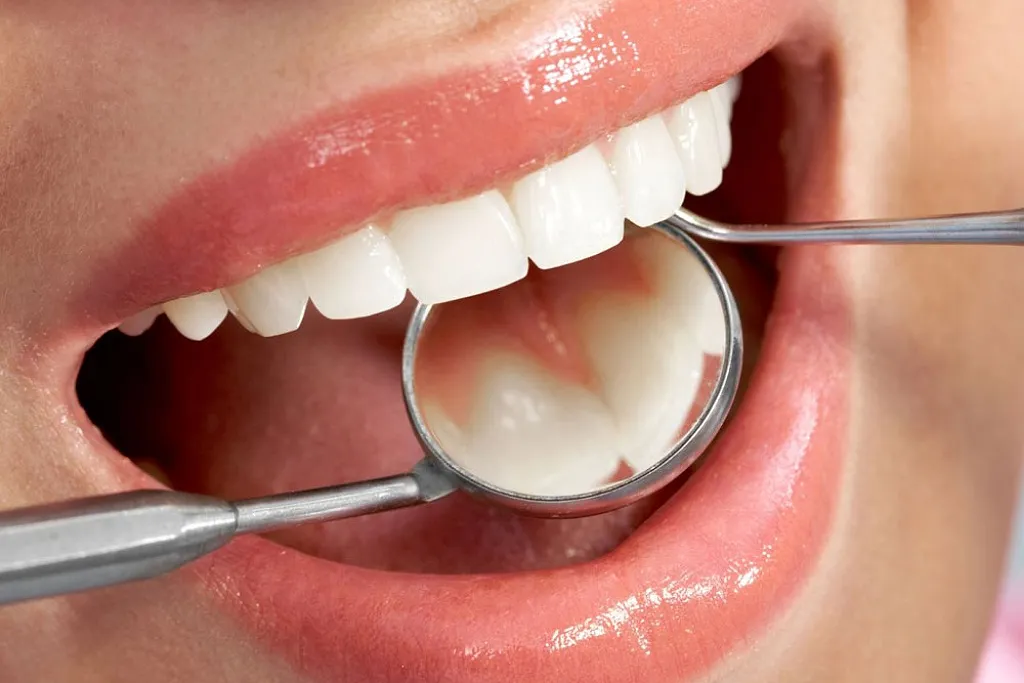 کامپوزیت دندان در کلینیک دندانپزشکی دکتر حقانی 