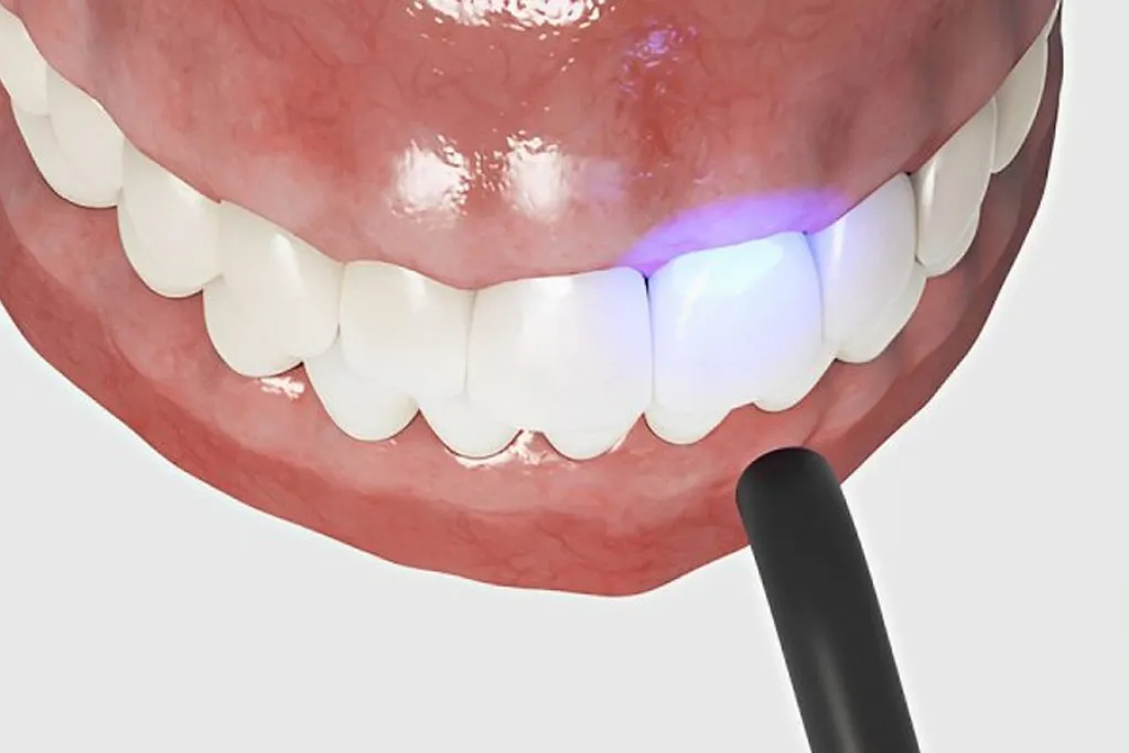 کامپوزیت طبیعی دندان در کلینیک دندانپزشکی دکتر حقانی در جردن تهران