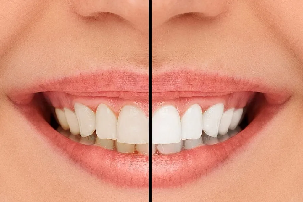 بلیچینگ دندان در کلینیک دندانپزشکی شمال تهران 