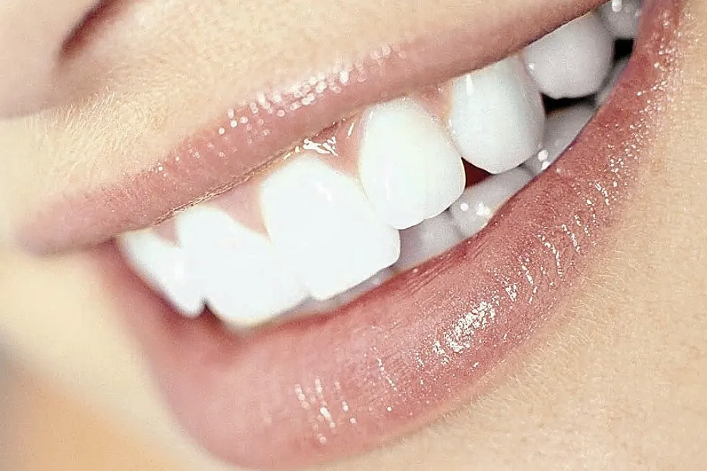 مزایای بلیچینگ دندان 