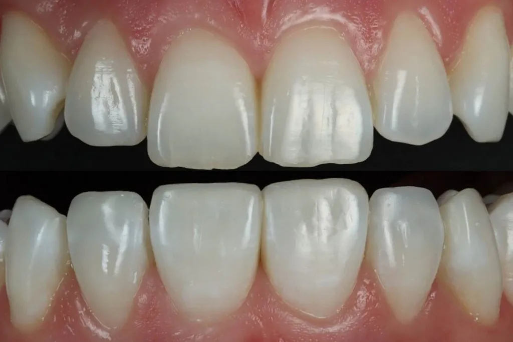 کامپوزیت دندان در تهران 