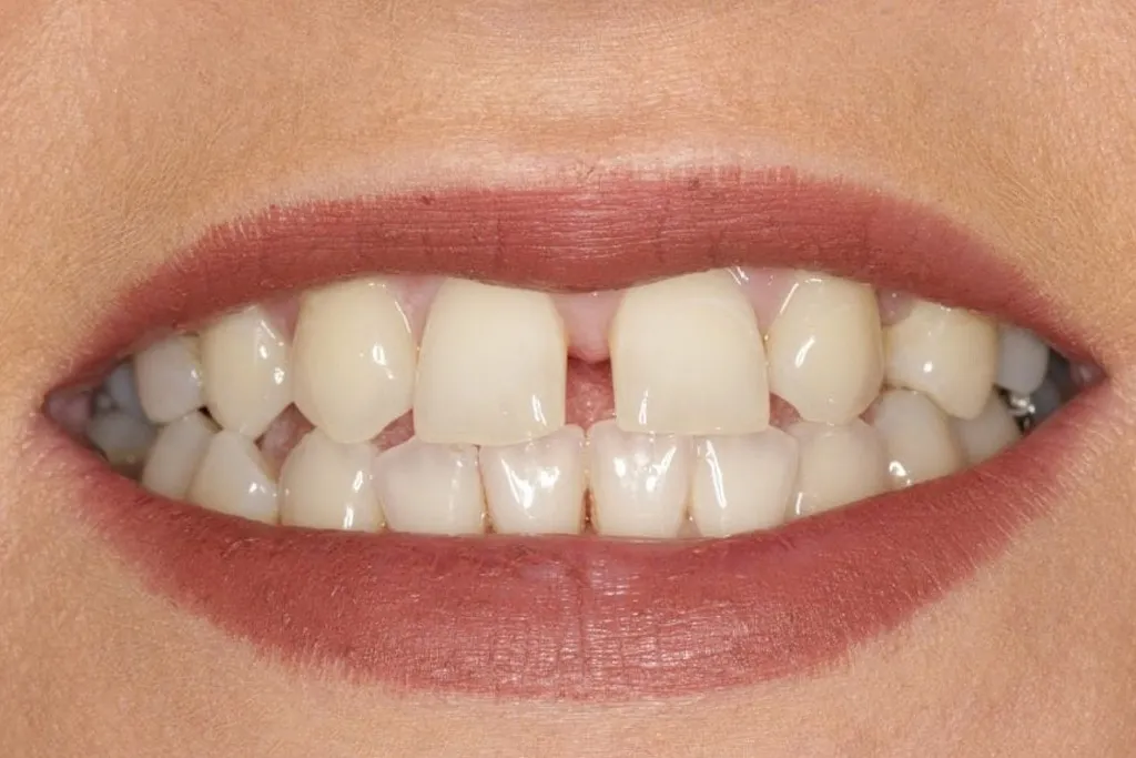 کامپوزیت ارزان و مزایای آن 