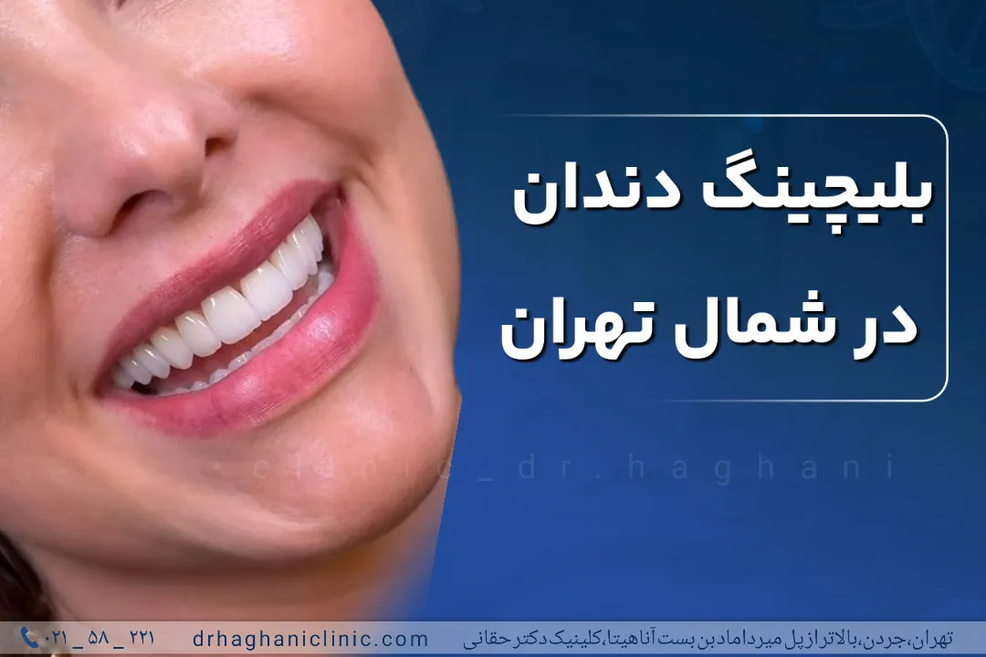 بلیچینگ دندان در شمال تهران