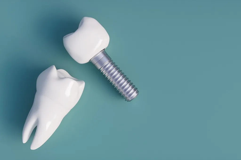 ایمپلنت دندان ها بدون بخیه در کلینیک دندانپزشکی دکتر حقانی