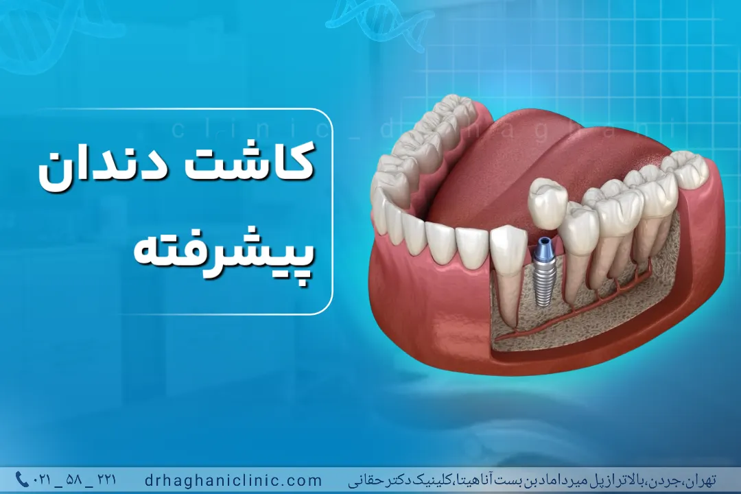 کاشت دندان پیشرفته