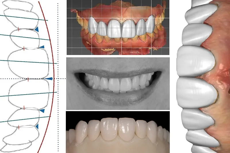 تکنولوژی‌های جدید در لمینت دندان پیشرفته