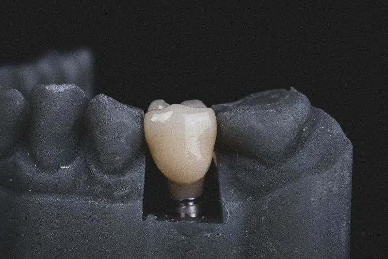 معایب ایمپلنت دندان