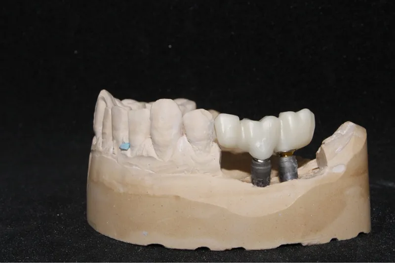 مزایای ایمپلنت دندان