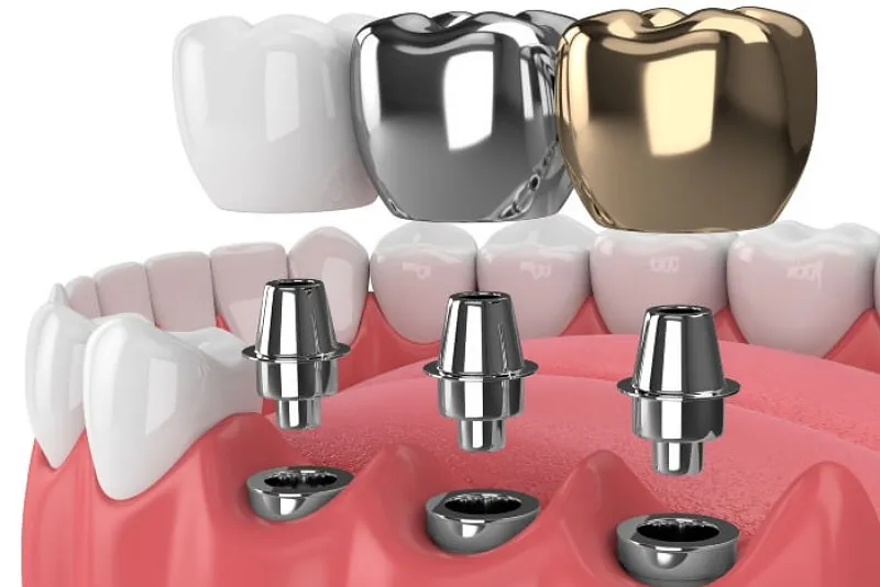 مقایسه مواد ایمپلنت