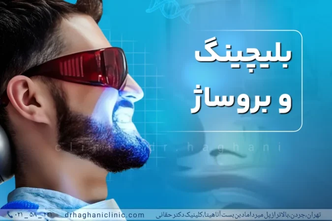 بلیچینگ و بروساژ