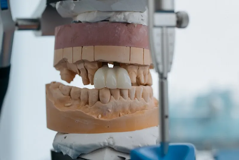 مزایا و معایب ببیچینگ و بروساژ