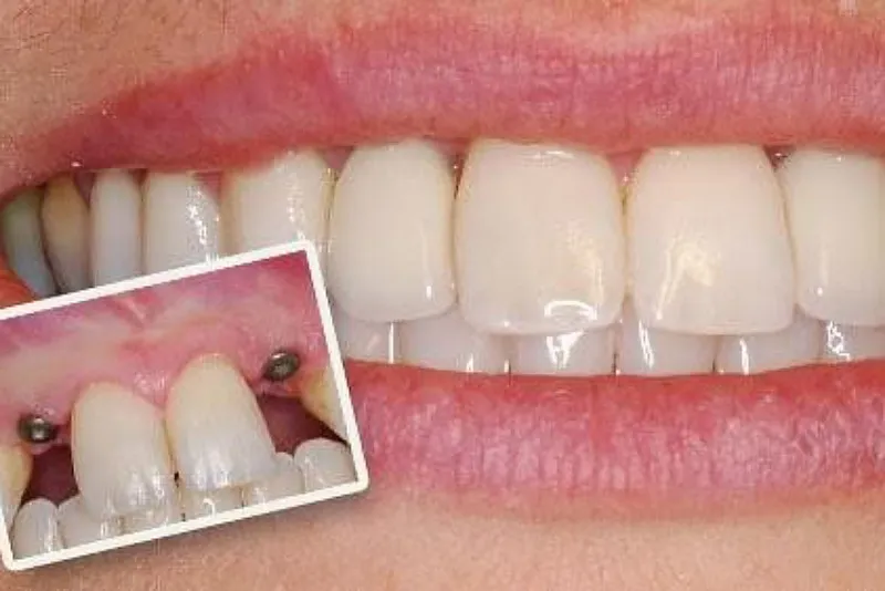 شناخت بیماریهای مزمن در موفقیت ایمپلنت دندان