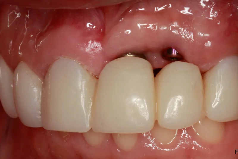 تأثیر بیماریهای خودایمنی بر روند ترمیم ایمپلنت