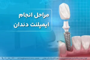 مراحل انجام ایمپلنت دندان