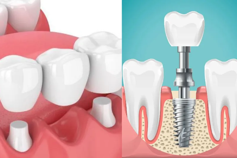 مزایا و معایب ایمپلنت و بریج