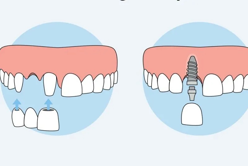 تفاوت ایمپلنت دندان و بریج از نظر ماندگاری