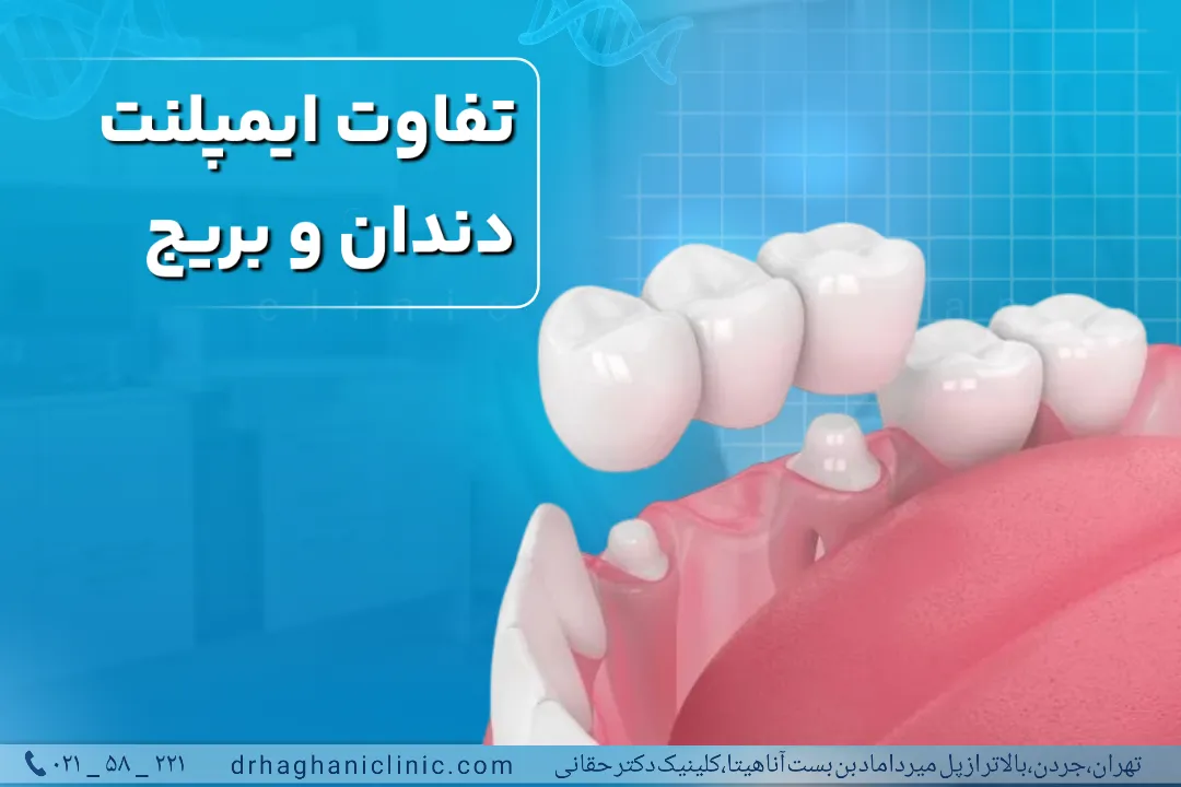 تفاوت ایمپلنت دندان و بریج