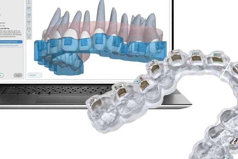 انواع ارتودنسی دیجیتال
