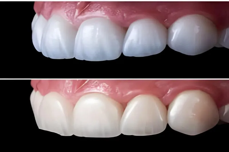 کامپوزیت دندان 