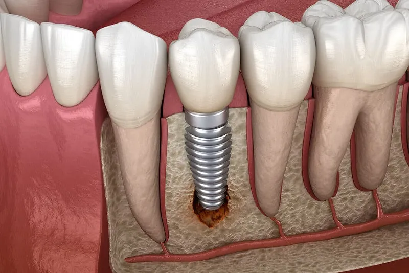 دلایل بروز عوارض ایمپلنت دندان