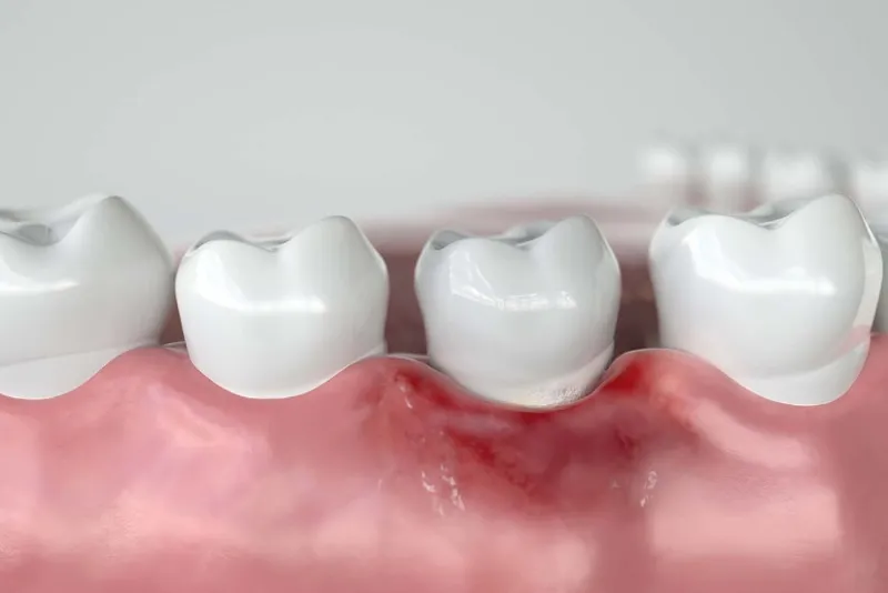 علتهای بروز عفونت در ایمپلنت دندان