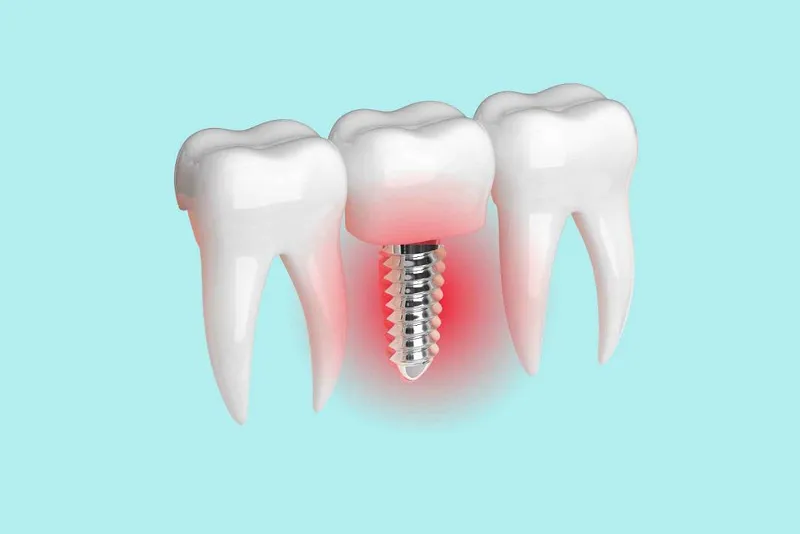 روشهای تشخیص عفونت ایمپلنت دندان