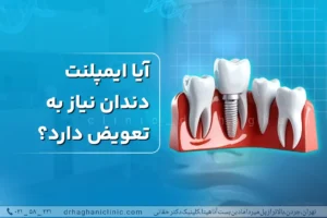 آیا ایمپلنت دندان نیاز به تعویض دارد؟