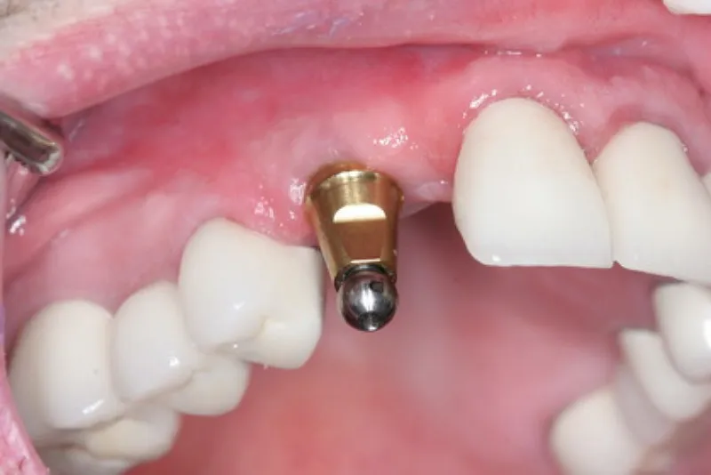 تعویض تاج ایمپلنت