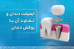 تفاوت ایمپلنت دندان و روکش دندان