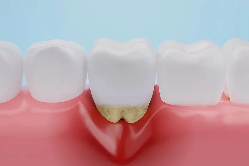 ایمپلنت دندان باعث التهاب لثه