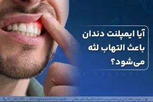 آیا ایمپلنت دندان باعث التهاب لثه می شود؟