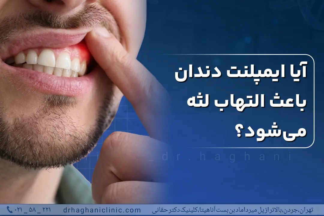 آیا ایمپلنت دندان باعث التهاب لثه می شود؟