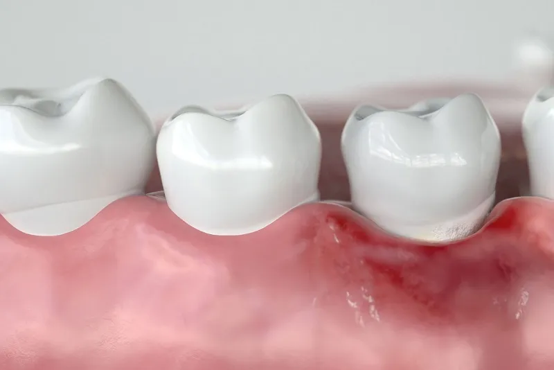 چگونه التهاب لثه بعد ایمپلنت را درمان کنیم؟  