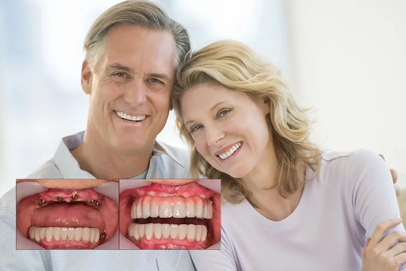 ایمپلنت در سالمندان