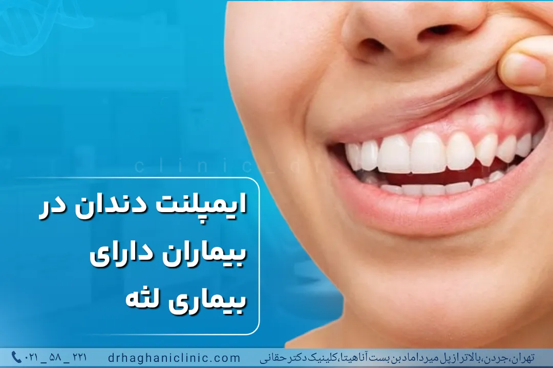 ایمپلنت دندان در بیماران دارای بیماری لثه
