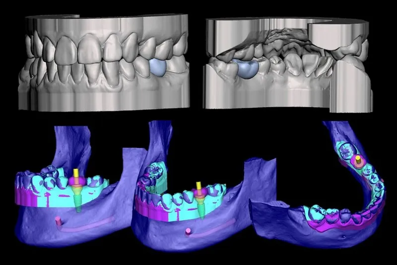 ایمپلنت دندان با فناوری CAD/CAM در کلینیک دندانپزشکی دکتر حقانی 