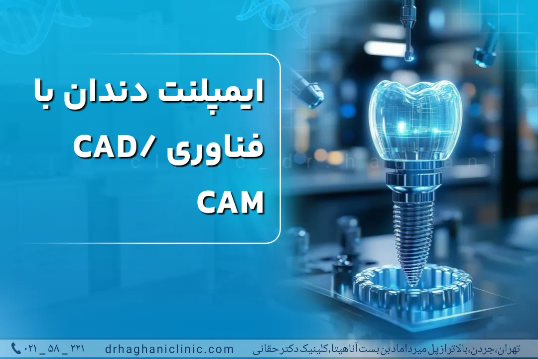 ایمپلنت دندان با فناوری cam cad