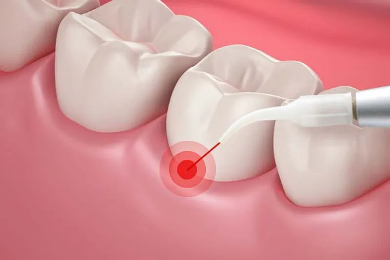 بهترین کاندیدای ایمپلنت دندان با لیزر