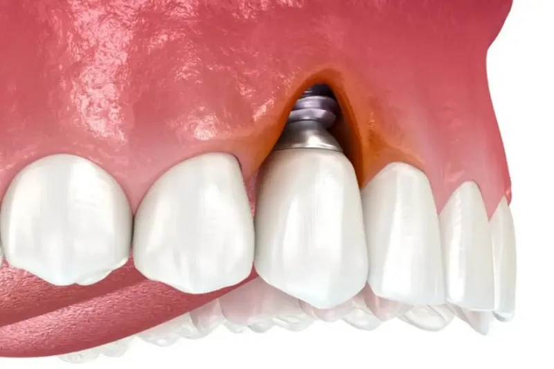 اهمیت تشخیص زودهنگام عفونت ایمپلنت